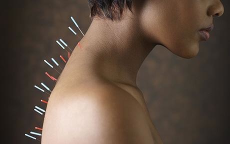 acupuncture_1248178c.jpg