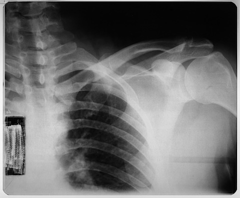 XRayShoulder0001_S.jpg